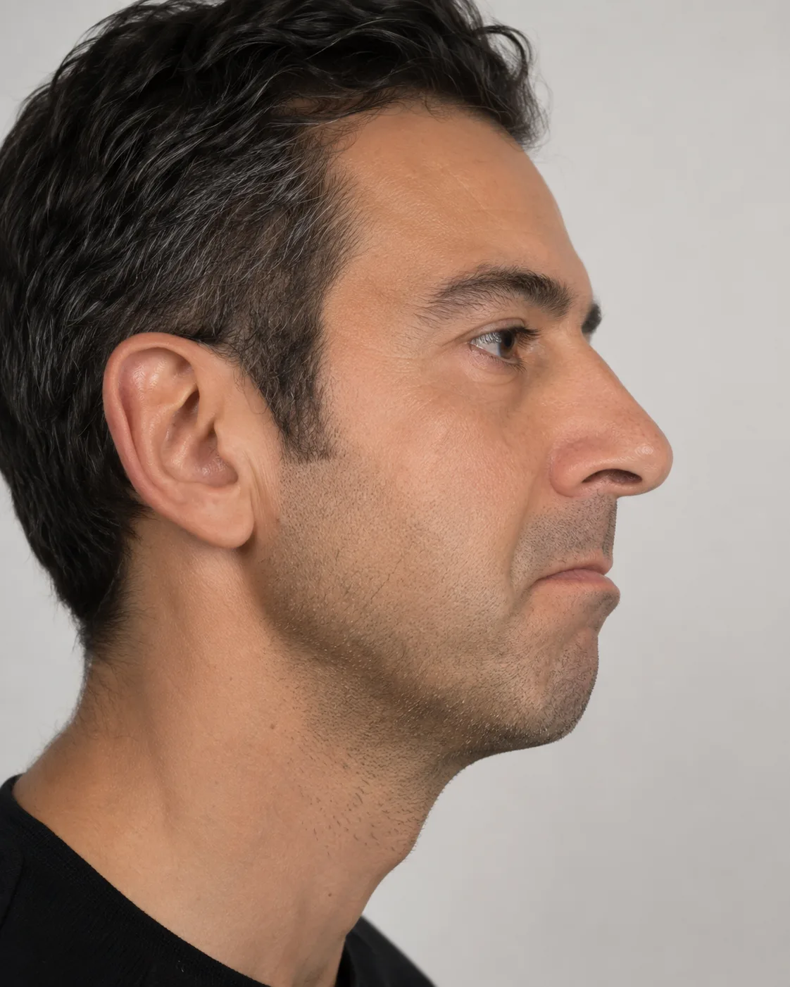 Side lip volume reference comparing profile projection and comfortable closure near Prahran
