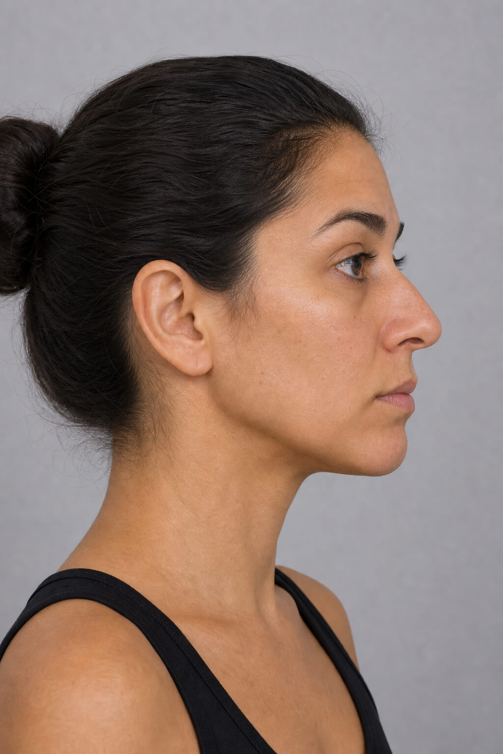 Lip and perioral consultation assessment for consultation planning at Core Aesthetics in Oakleigh