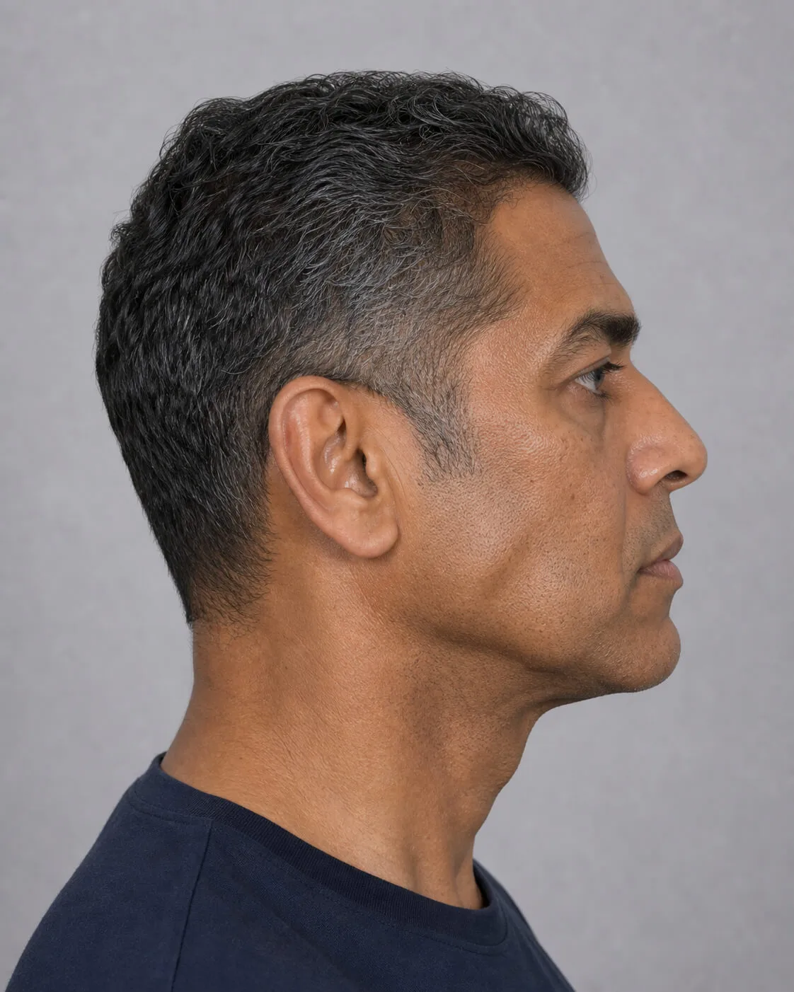 Masseter male side 02 educational reference for Jaw Muscle Consultation Bentleigh East