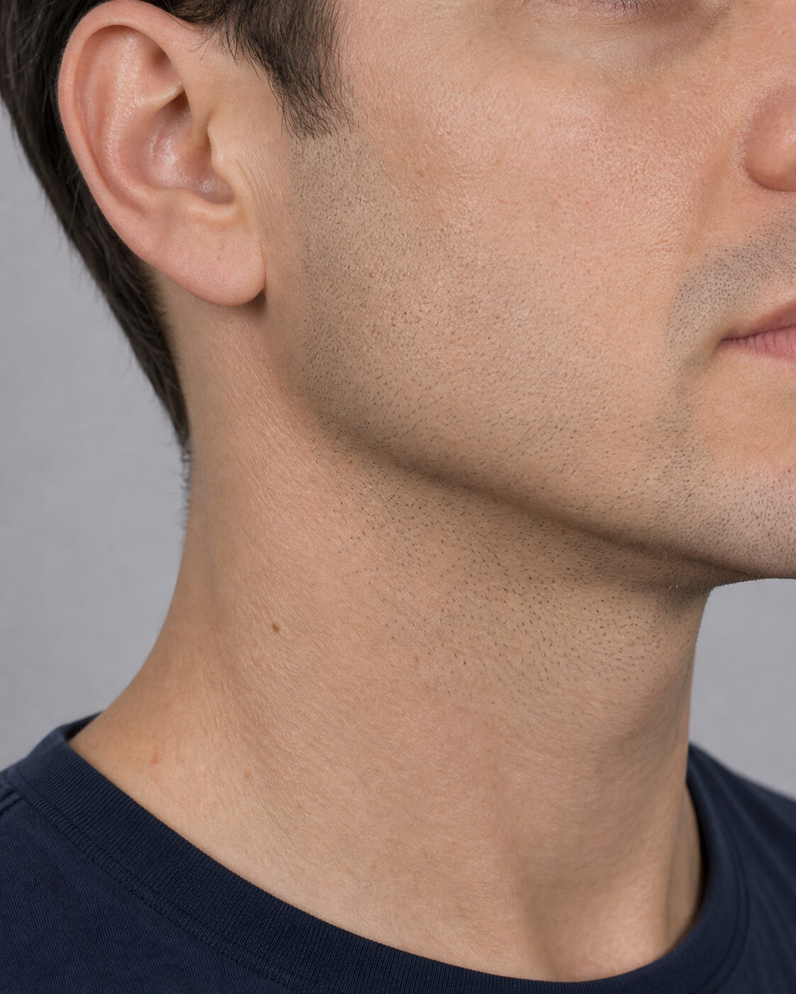 Chin and jawline consultation assessment for consultation planning at Core Aesthetics in Oakleigh
