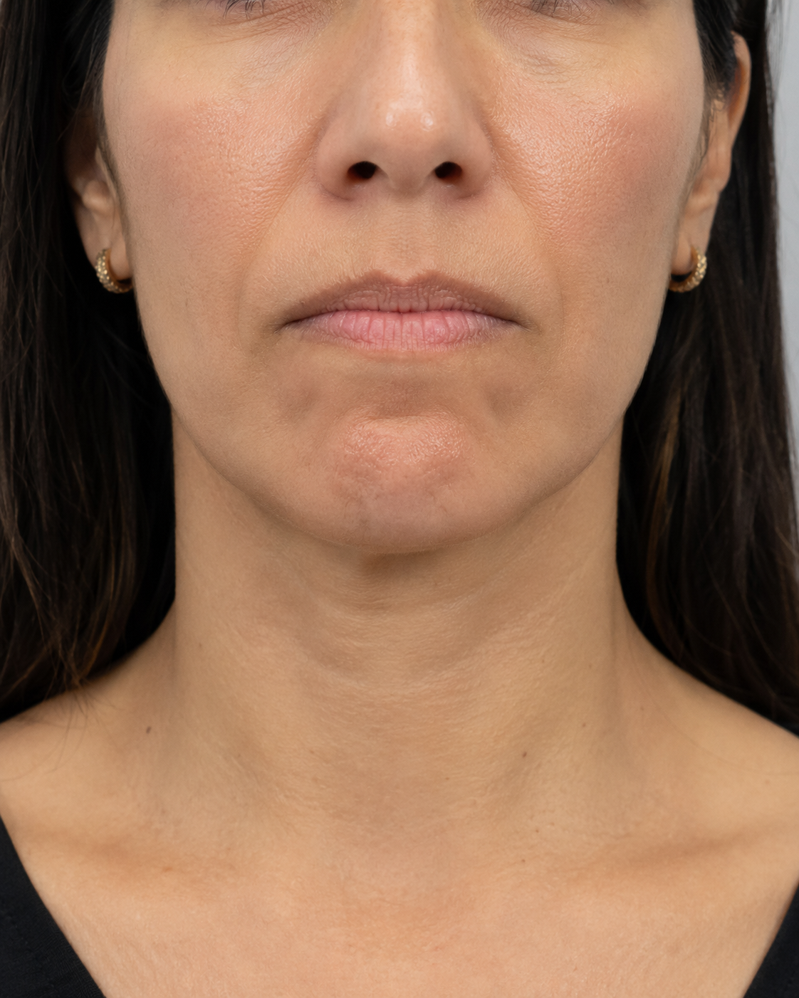 Lip and perioral consultation assessment for consultation planning at Core Aesthetics in Oakleigh
