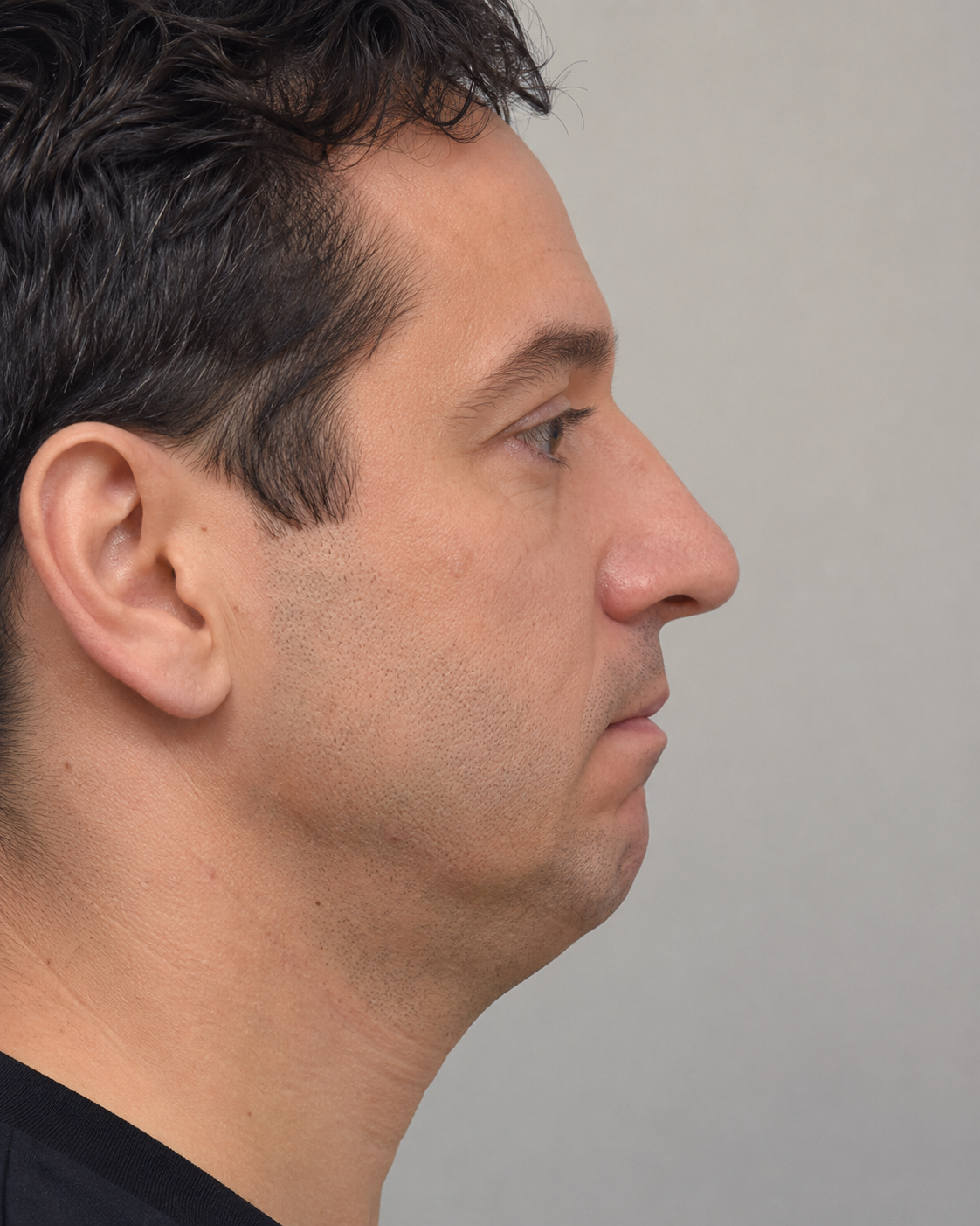 Chin and jawline consultation assessment for consultation planning at Core Aesthetics in Oakleigh