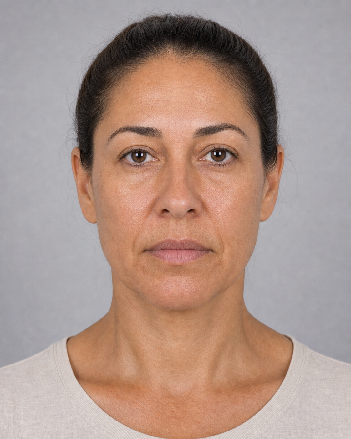 Lip and perioral consultation assessment for consultation planning at Core Aesthetics in Oakleigh