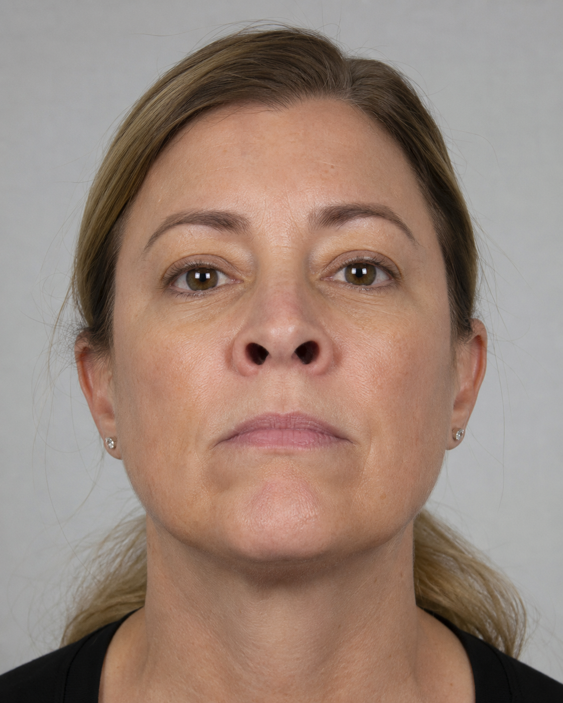 Facial structure consultation assessment for consultation planning at Core Aesthetics in Oakleigh