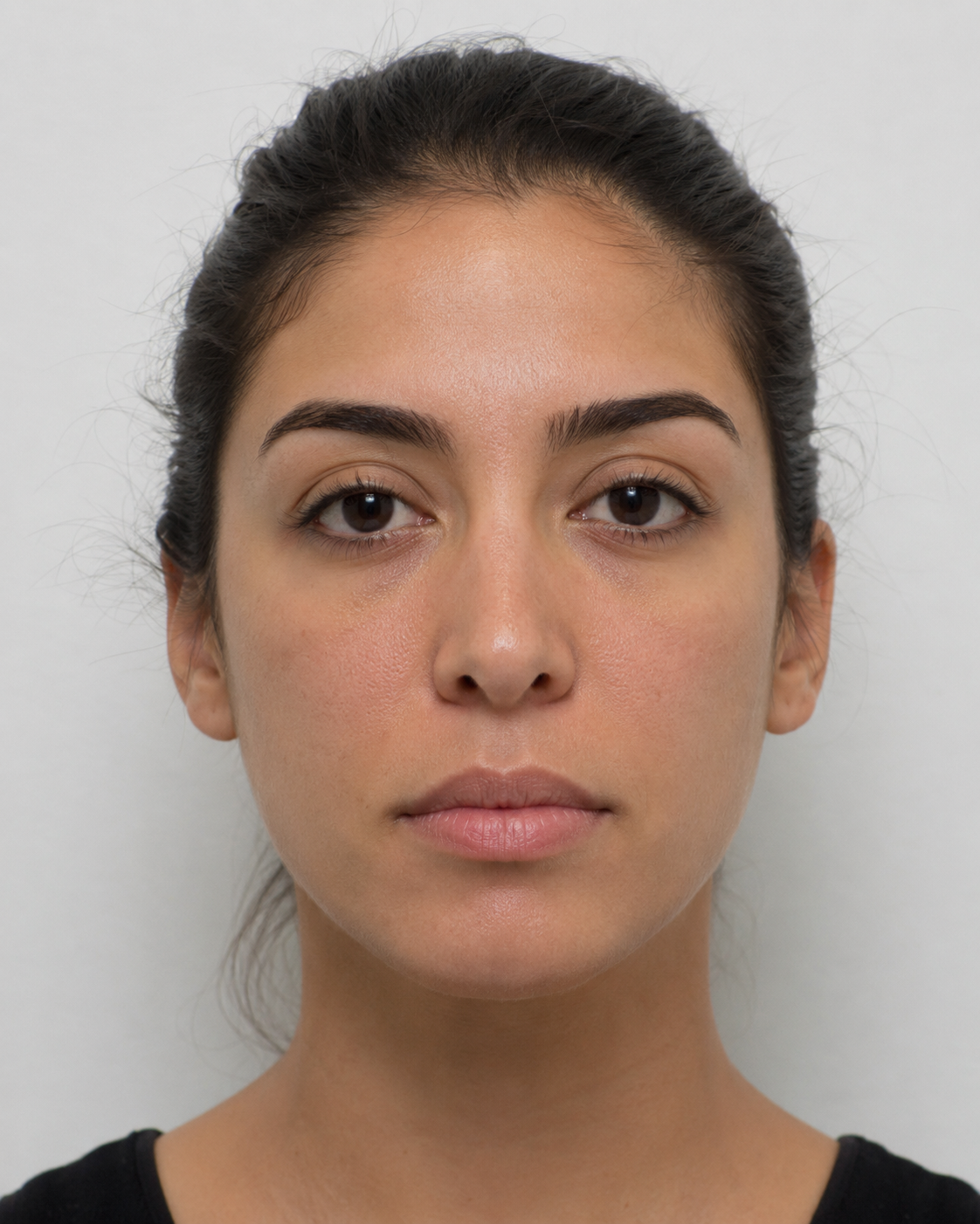 Wrinkle and upper-face consultation assessment for consultation planning at Core Aesthetics in Oakleigh