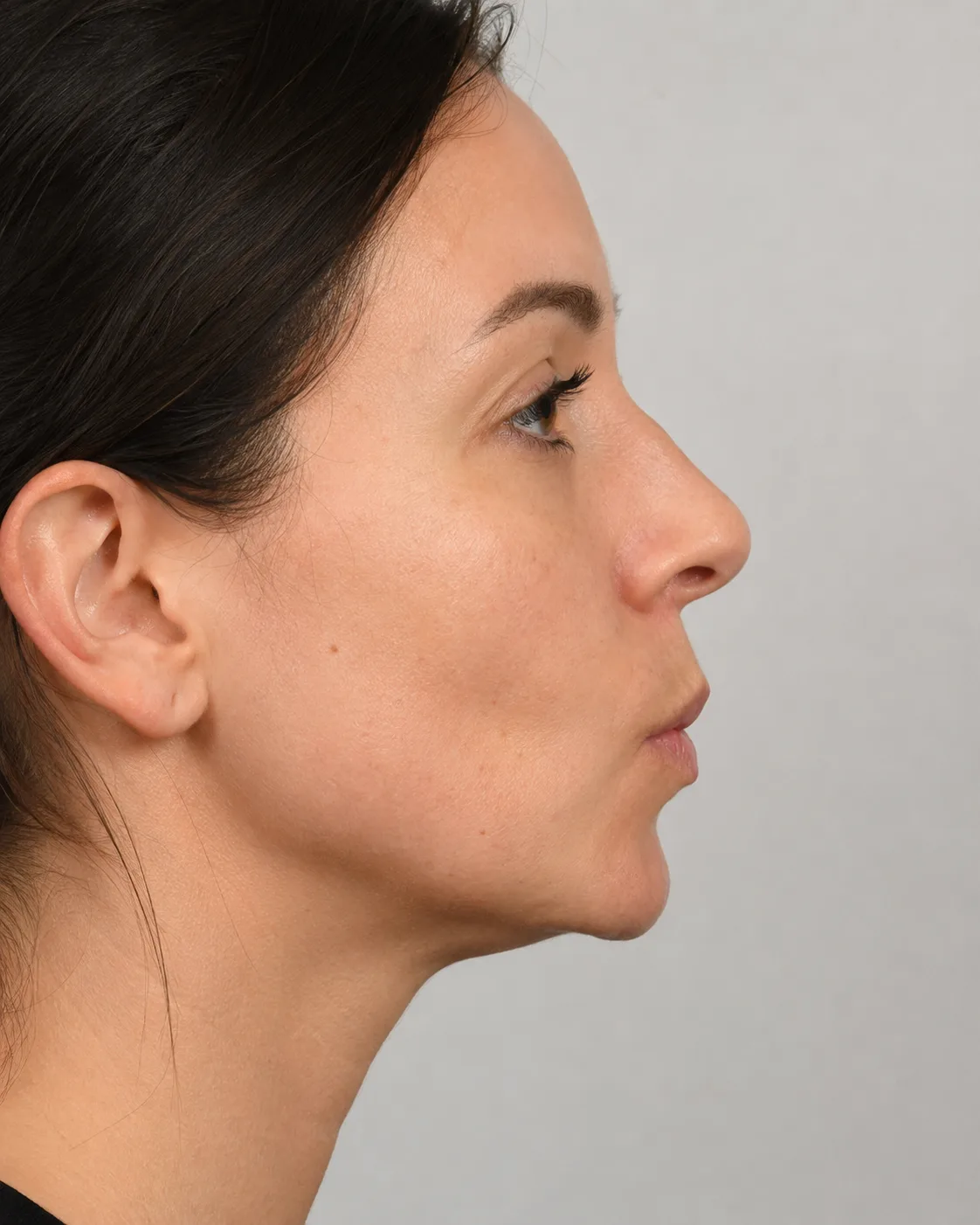 Side view used to discuss facial proportions during consultation education