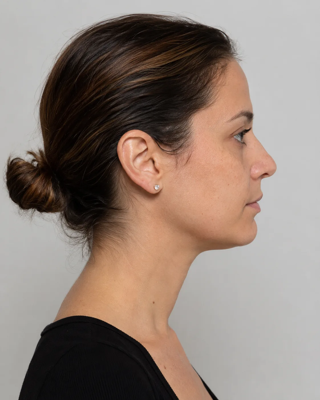 Side lower face view showing the jaw angle and neck relationship during McKinnon assessment