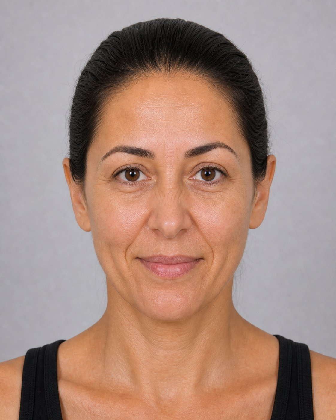 Under-eye consultation assessment for consultation planning at Core Aesthetics in Oakleigh