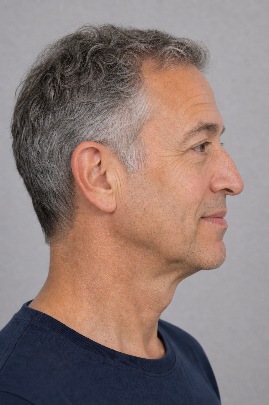 Under-eye consultation assessment for consultation planning at Core Aesthetics in Oakleigh