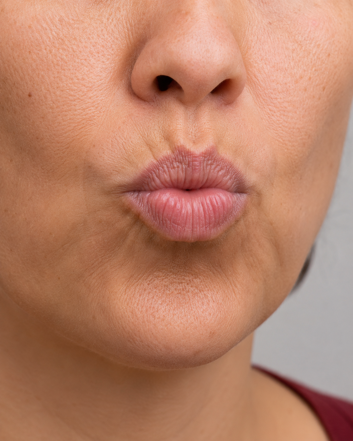 Lip and perioral consultation assessment for consultation planning at Core Aesthetics in Oakleigh