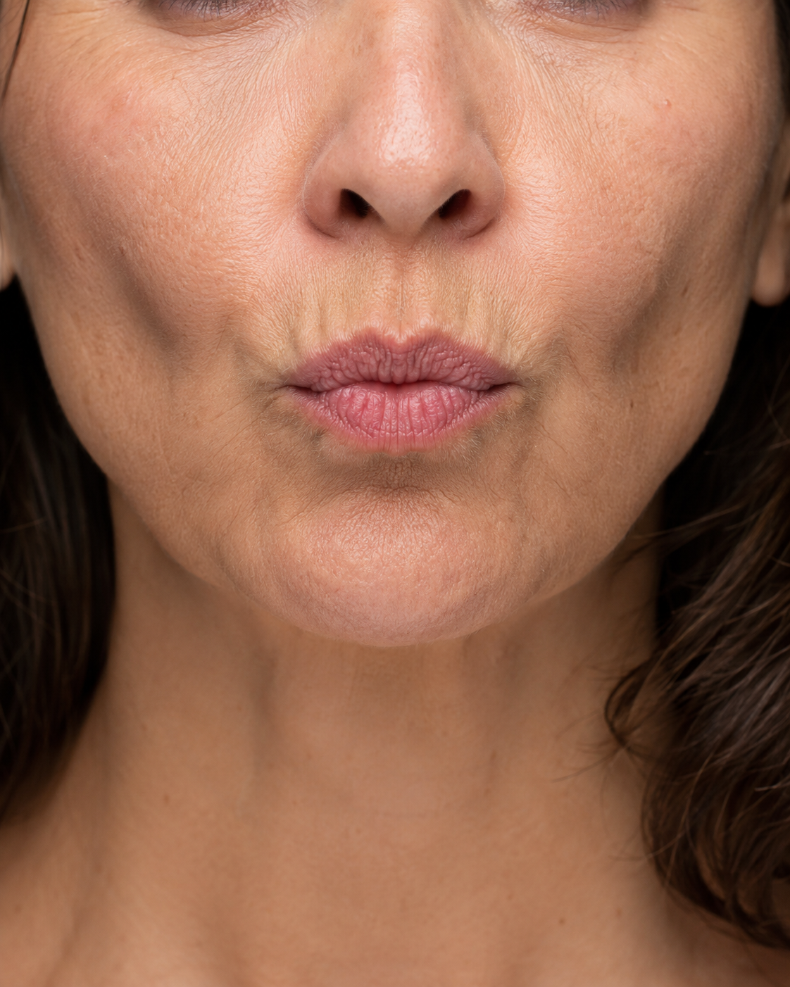 Lip and perioral consultation assessment for consultation planning at Core Aesthetics in Oakleigh