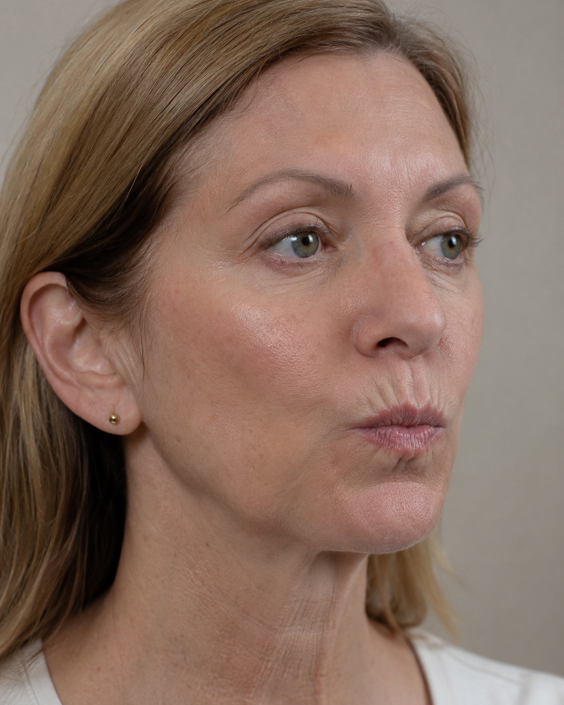 Lip and perioral consultation assessment for consultation planning at Core Aesthetics in Oakleigh
