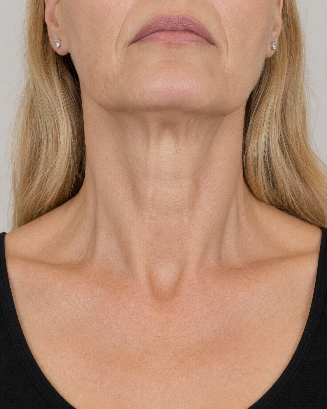 Neck band movement assessment reference for neck bands consultation at Core Aesthetics Oakleigh