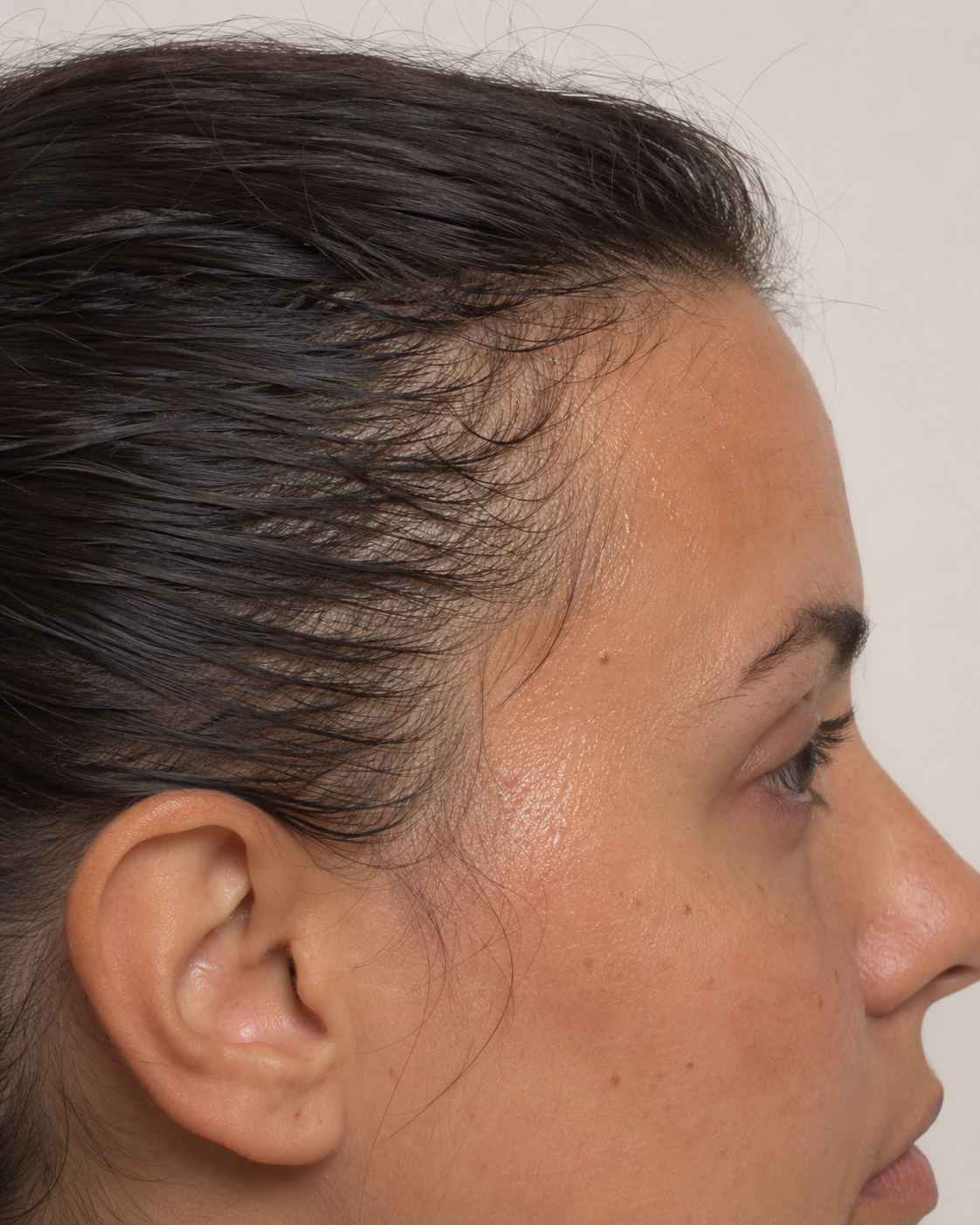 Underarm sweating consultation assessment for consultation planning at Core Aesthetics in Oakleigh