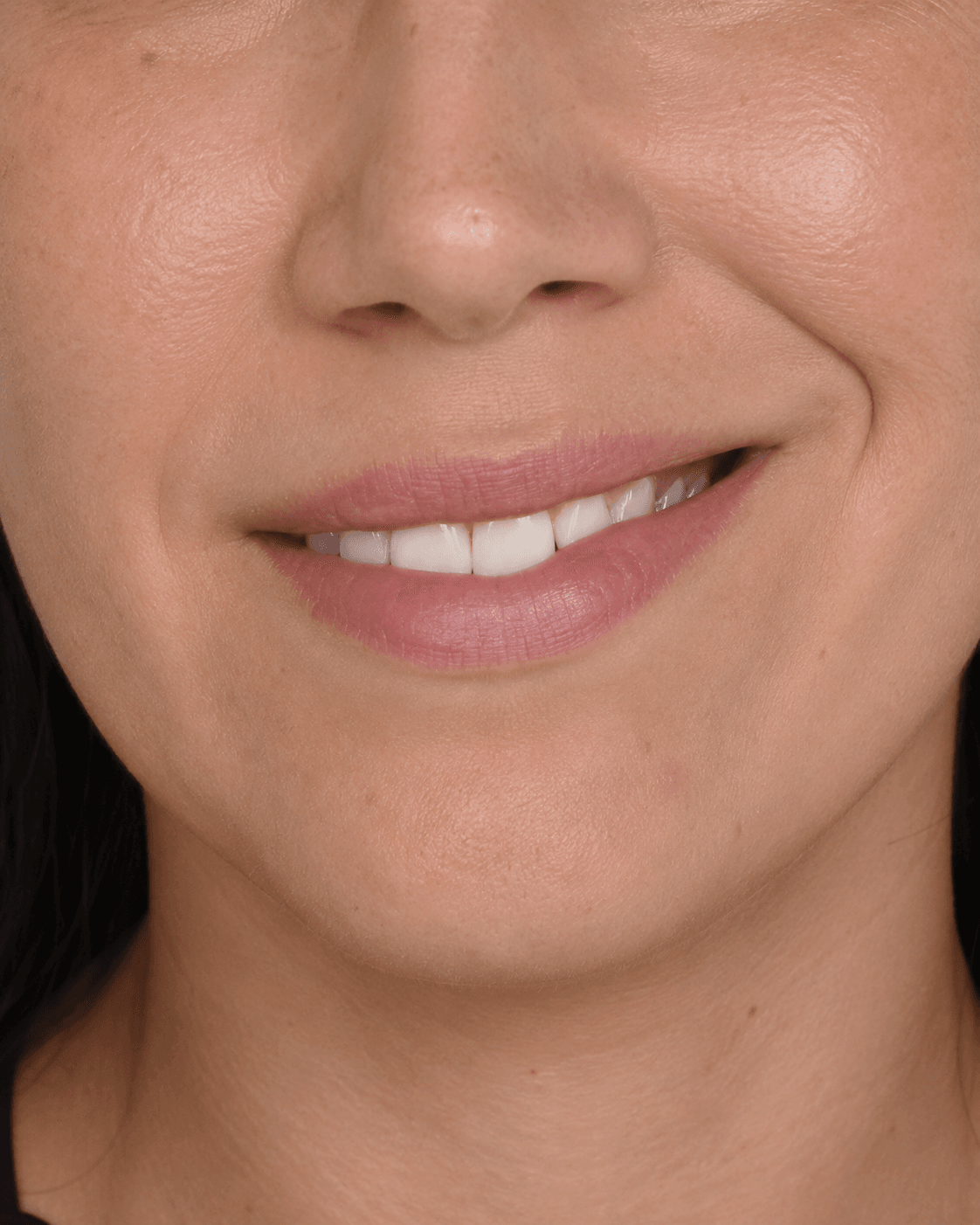 Close lip and smile assessment reference for lip volume consultation at Core Aesthetics Oakleigh