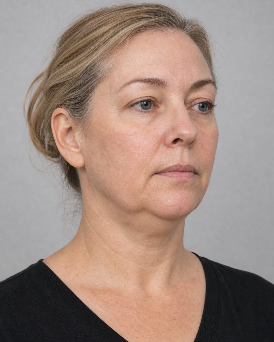 Adult woman in three-quarter view for a jawline, chin and lower-face assessment discussion