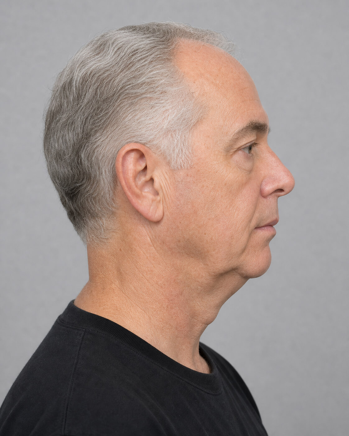 Chin and jawline consultation assessment for consultation planning at Core Aesthetics in Oakleigh
