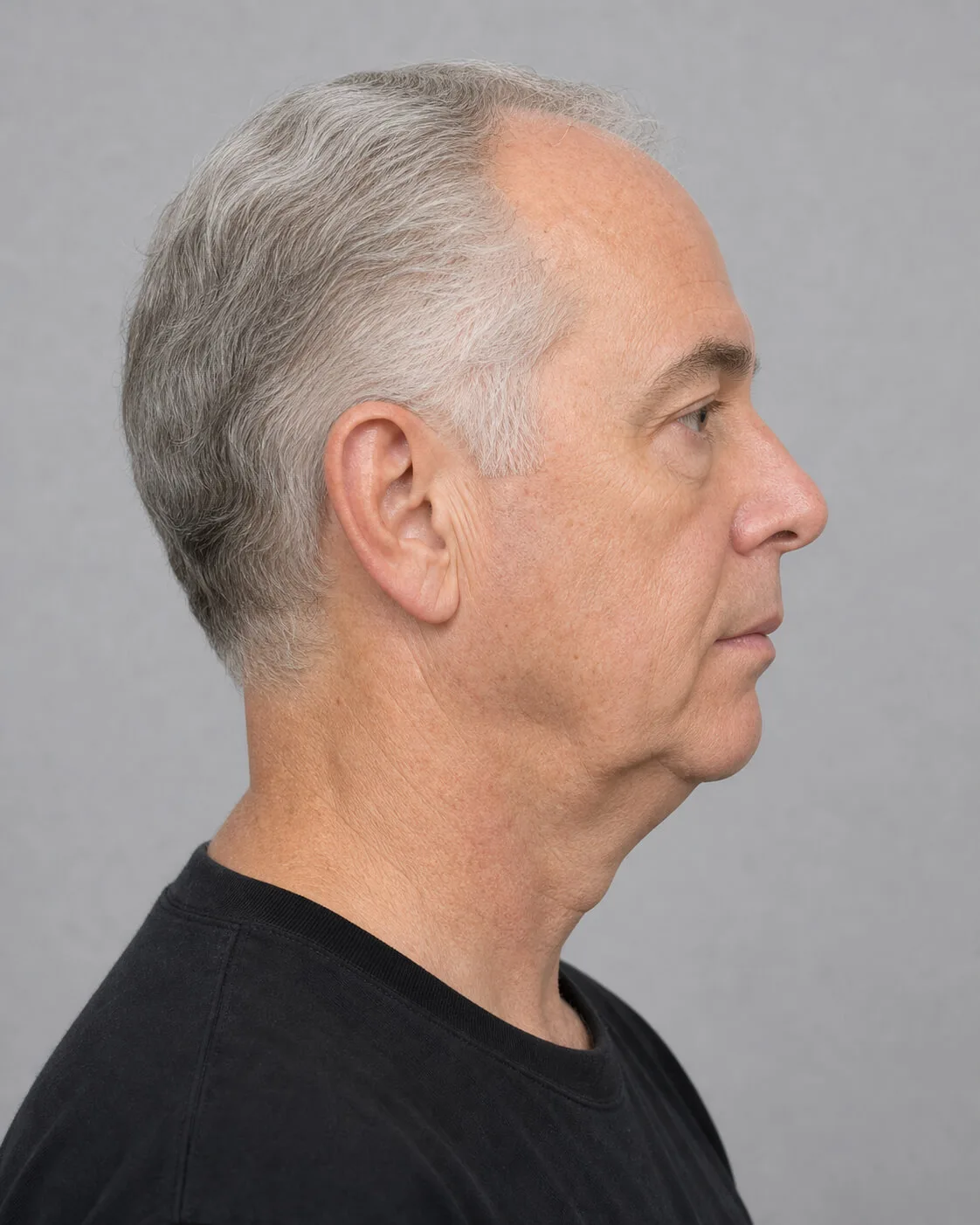 Male side lower face and neck view showing a jawline border and jaw to neck transition