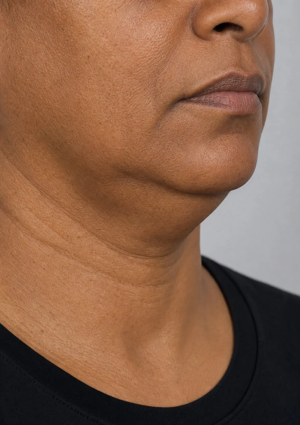 Neutral close lower face view used to compare relaxed jaw width and outline