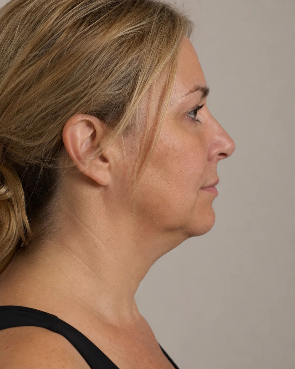 Private lower-face assessment image used to explain review, waiting or no-treatment pathways during consultation planning