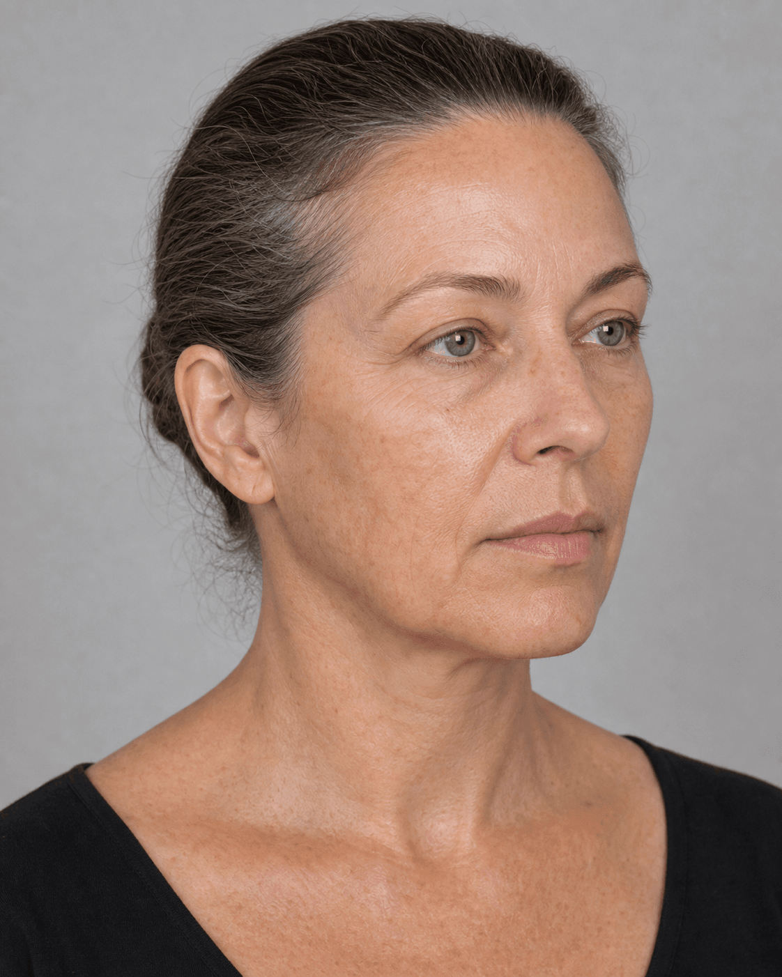Three-quarter temple assessment reference for temple consultation at Core Aesthetics Oakleigh