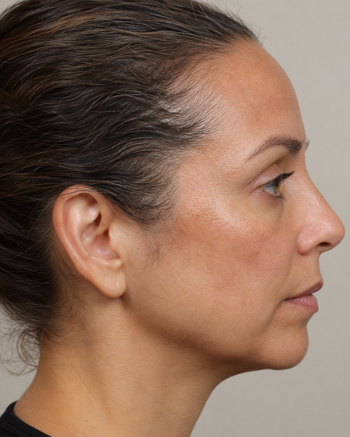 Lip and perioral consultation assessment for consultation planning at Core Aesthetics in Oakleigh