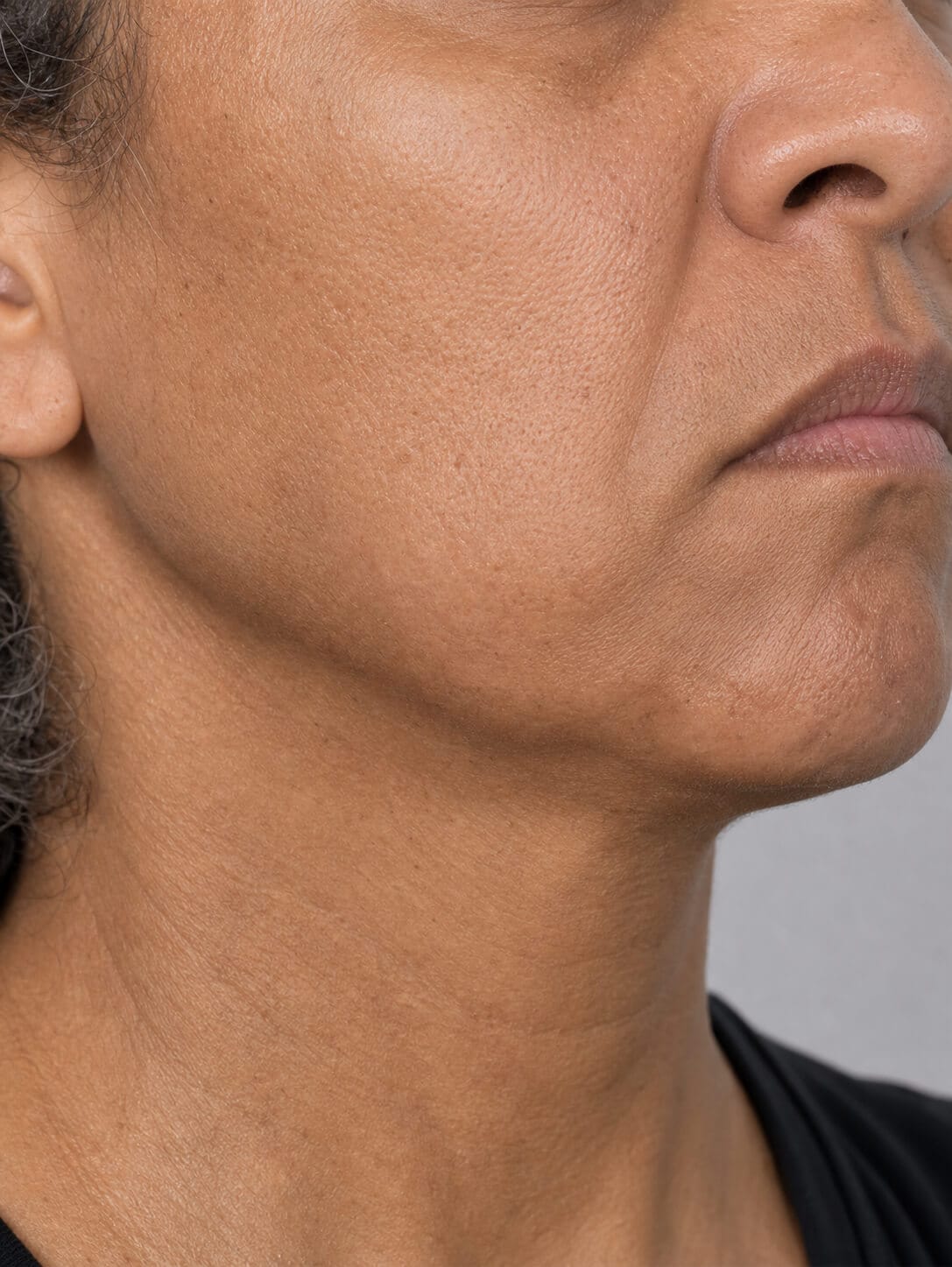 Adult patient in side profile during a jawline and lower face assessment at Core Aesthetics in Oakleigh