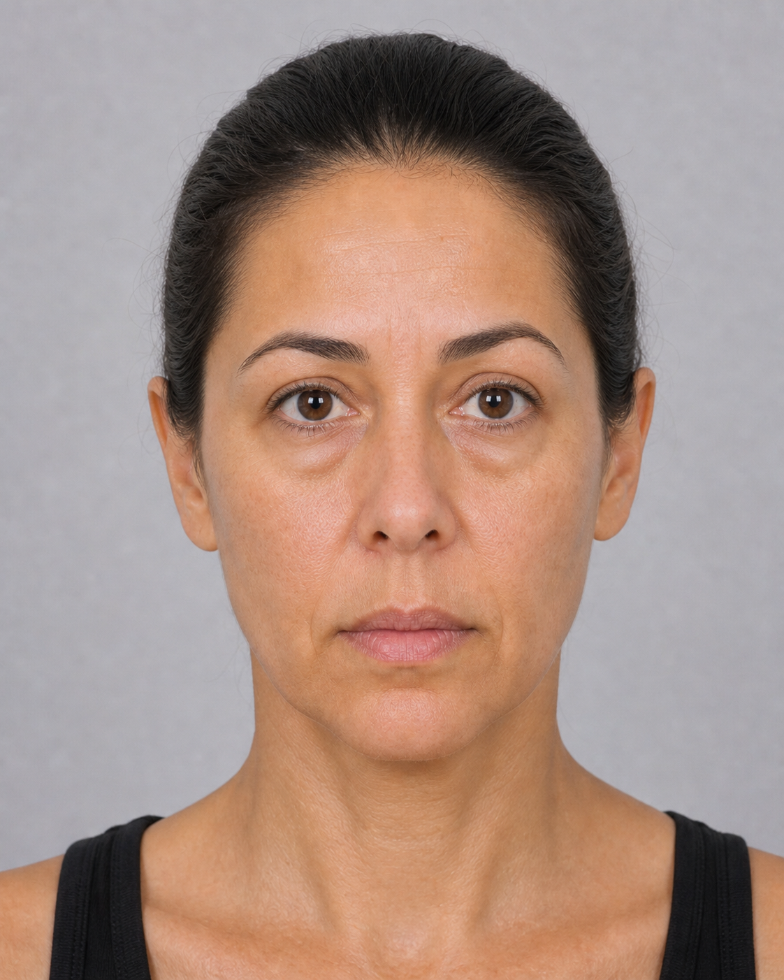 Under eye assessment reference for tear trough consultation at Core Aesthetics Oakleigh