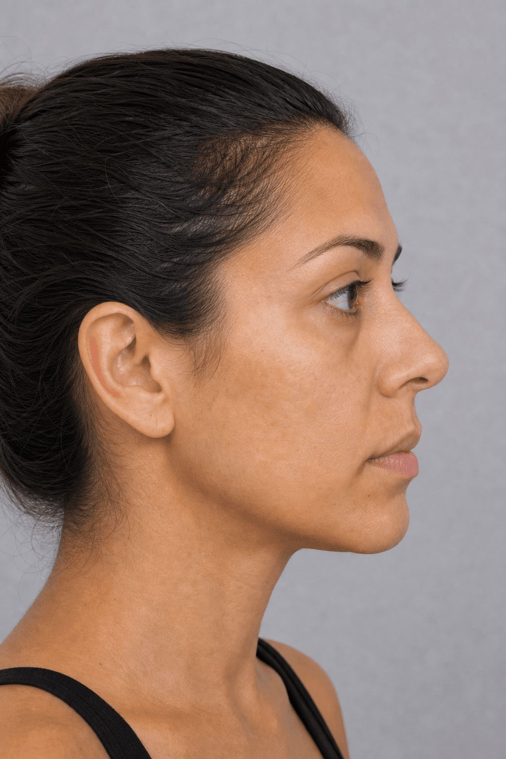 Side view of an adult woman showing the natural transition between the lower eyelid and upper cheek