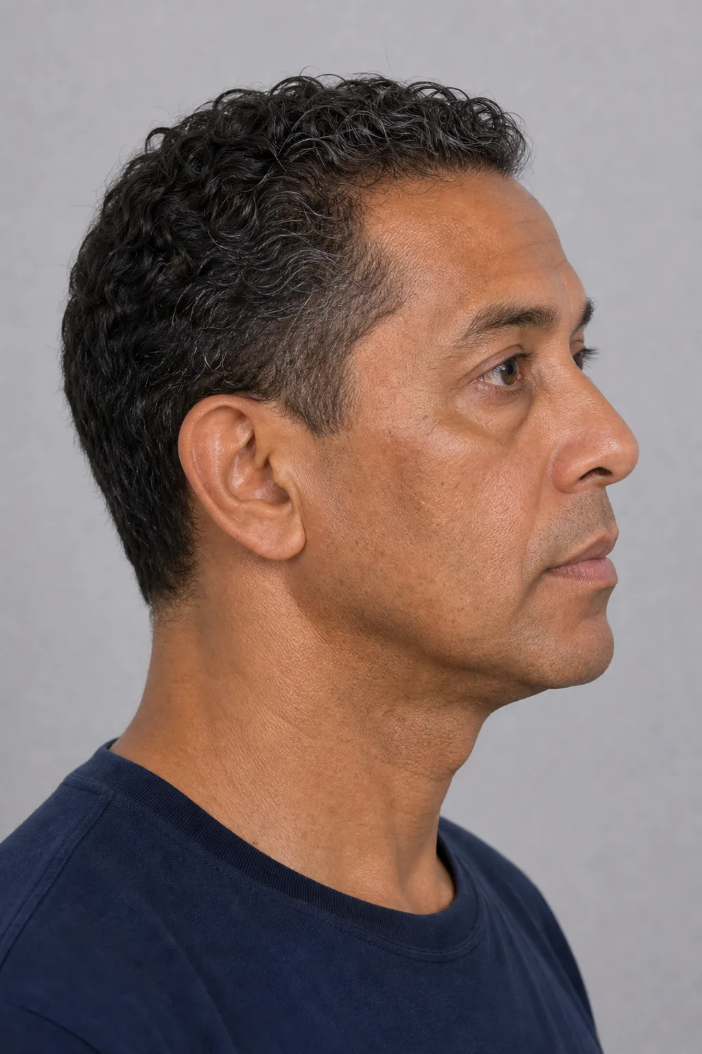 Consultation image for discussing why more cheek volume is not always the right answer