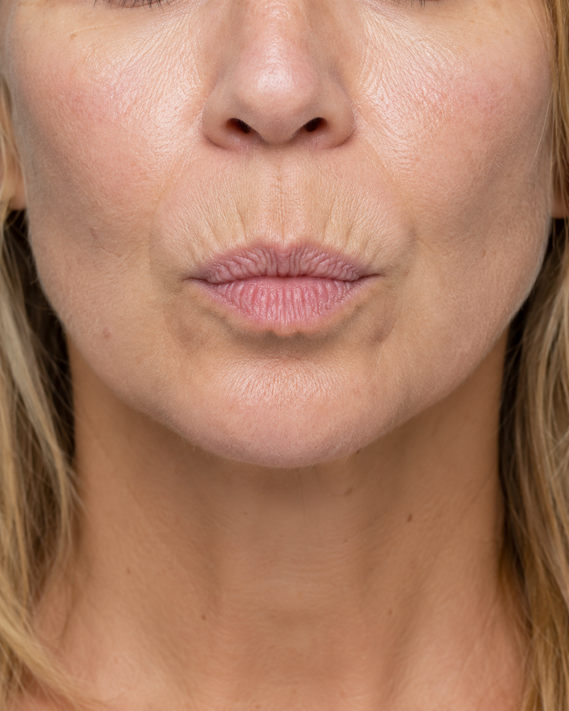 Lip and perioral consultation assessment for consultation planning at Core Aesthetics in Oakleigh