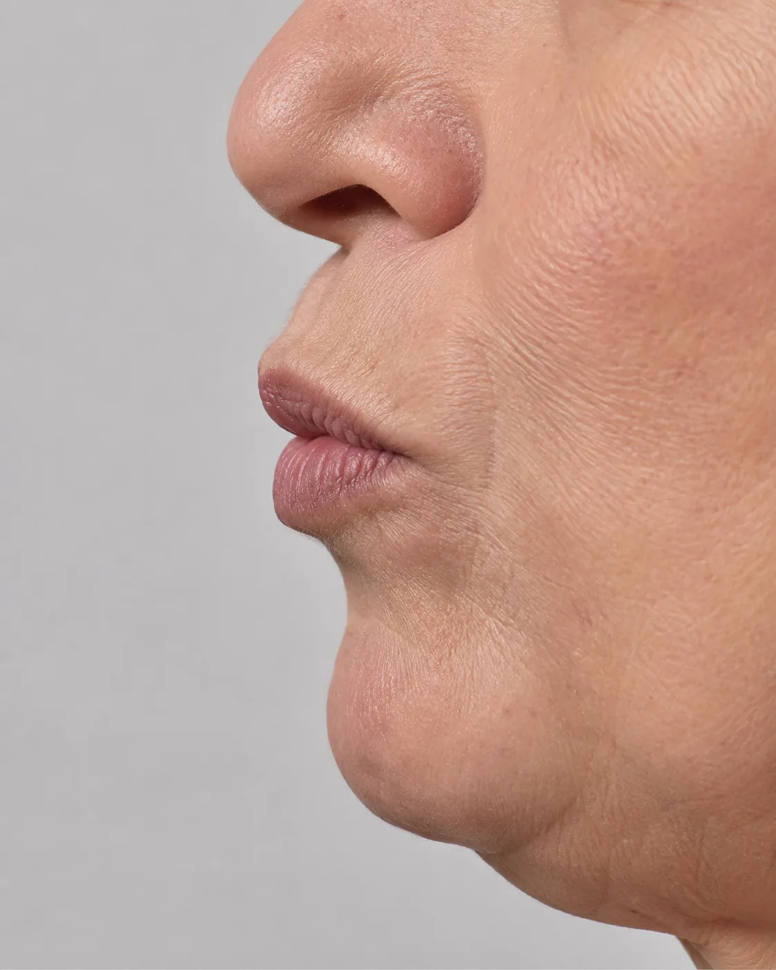 Side educational view of an older adult woman showing the upper lip border and surrounding skin at rest