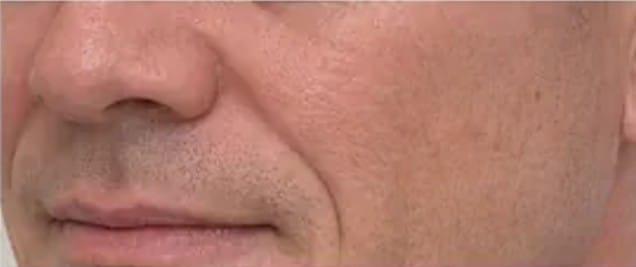 Core Aesthetics male lips side natural