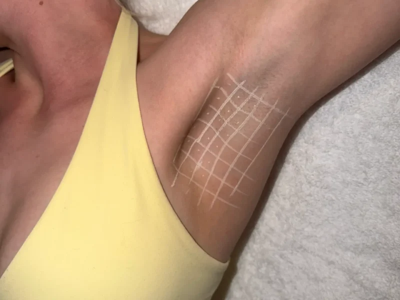 Hyperhidrosis treatment assessment at Core Aesthetics in Oakleigh